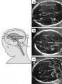 Ультразвуковое исследование мозга новорожденных детей (нормальная анатомия)
